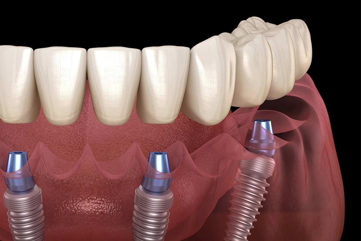 3D model showing how dental implants are placed