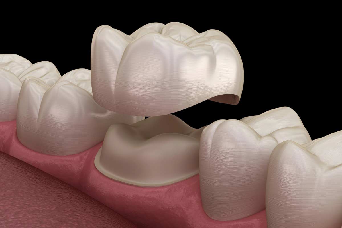 3D model showing how a dental crown is placed