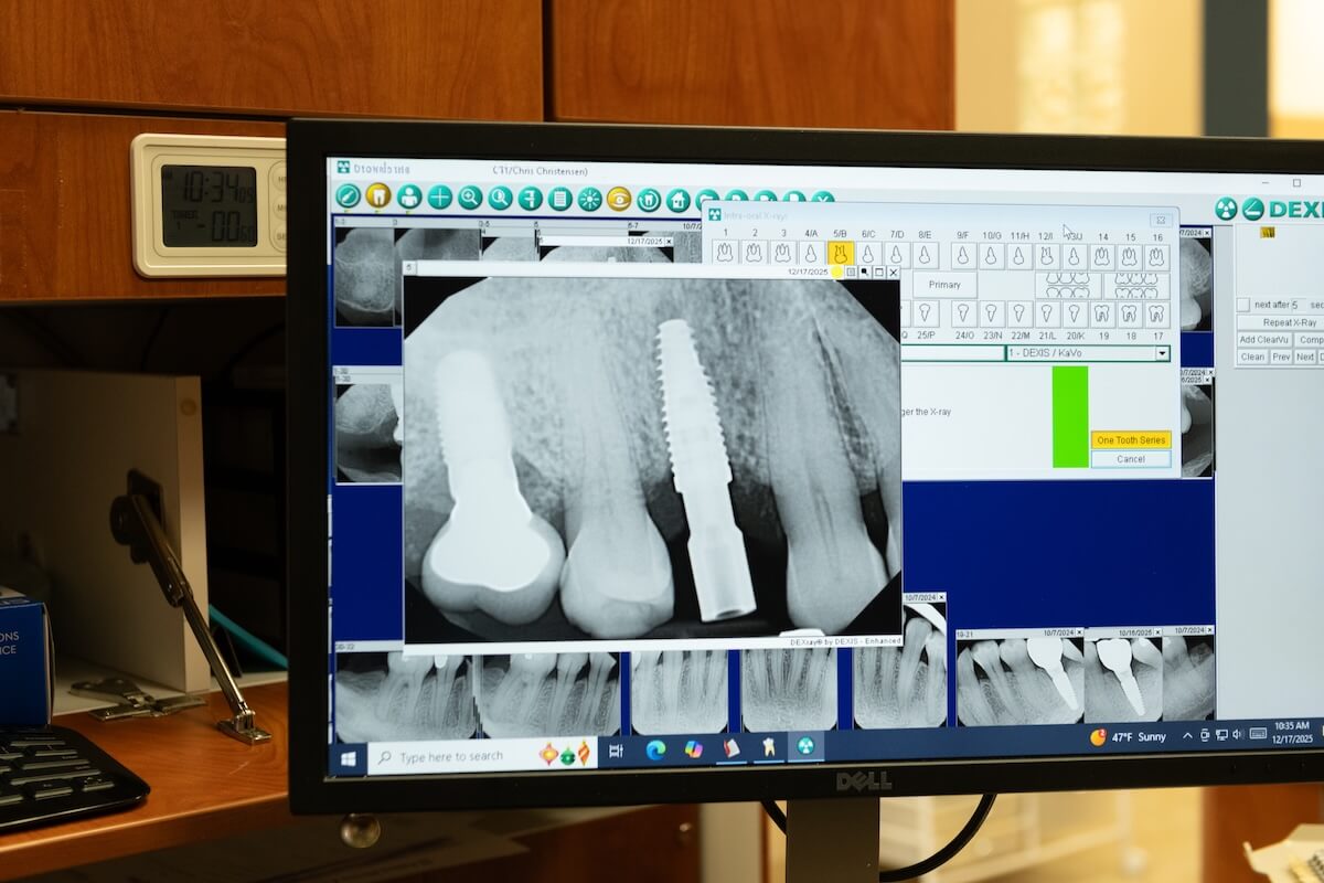 An image of dental X-Rays with dental implants as part of dental implant solutions at Sandia View in Rio Ranch NM.